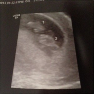 First ultrasound 3/9/14
